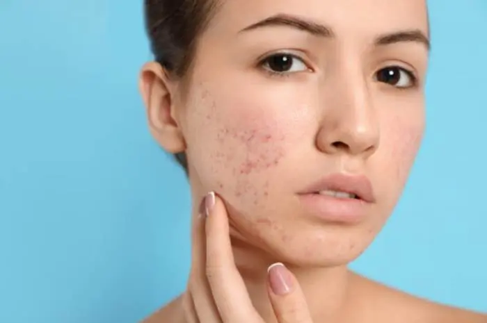 10 Tips to Remove Black Spots Proven Effectively with Natural Ingredients